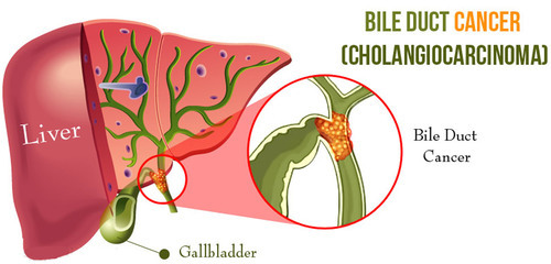 Japanese Researchers Discover New Biomarker For Bile Duct Cancer Thailand Medical News