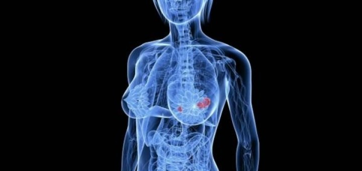breast cancer bone metastasis