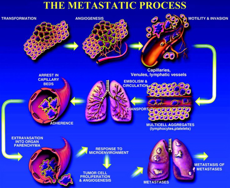 metastatic cancer