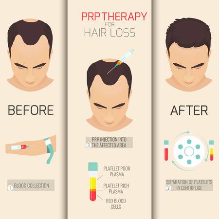 plasma injections