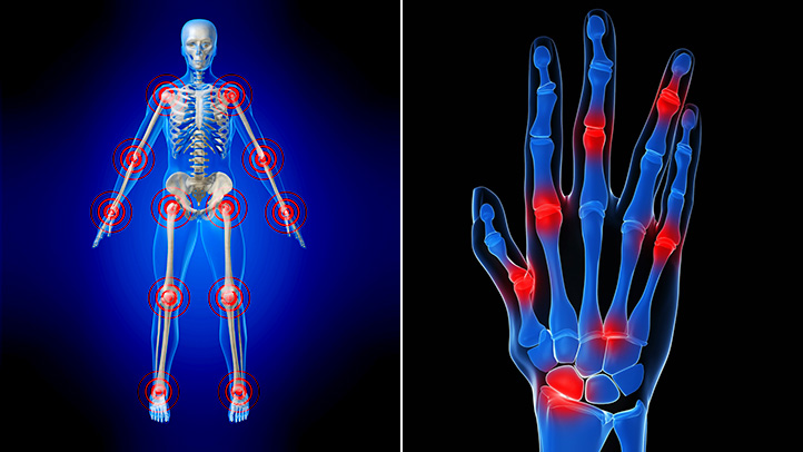 rheumatoid arthritis