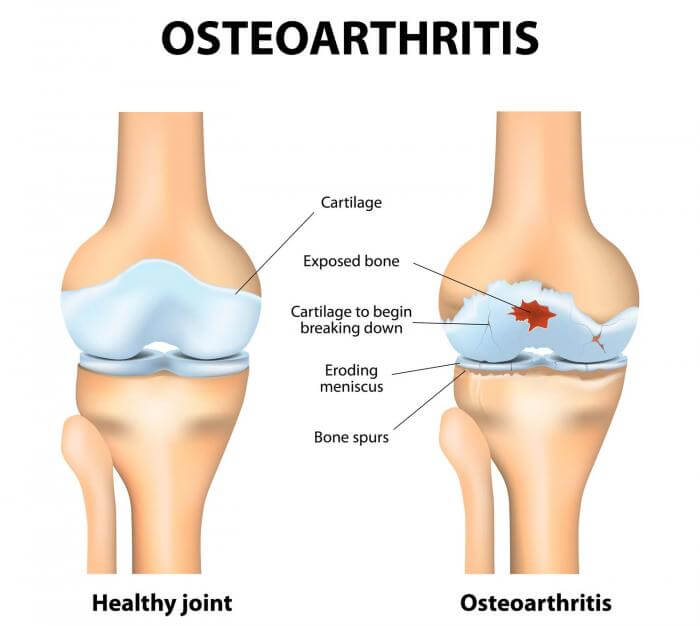 spine osteoarthritis