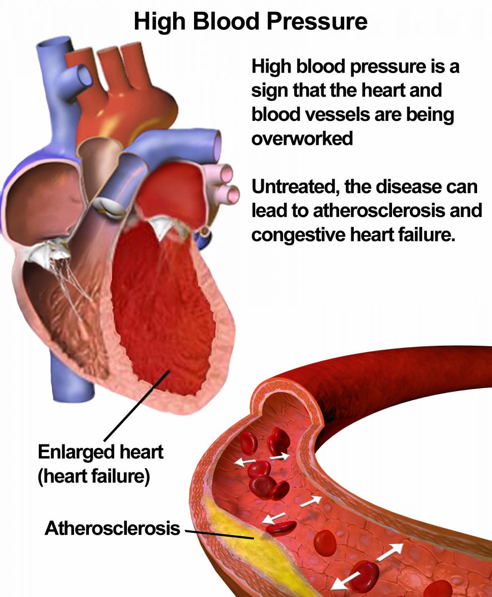 the Future Drug for Hypertension