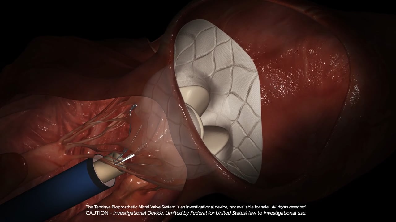 transcatheter-mitral