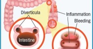 Antiinflamatorio para diverticulitis